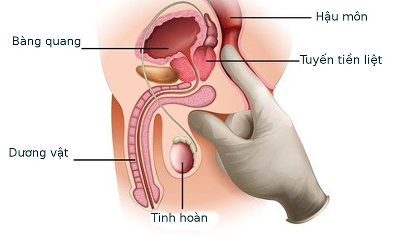 Nguyên Nhân Thường Gặp Gây Viêm Tuyến Tiền Liệt Và Cách Phòng Ngừa 1 Hình ảnh tuyến tiền liệt bình thường và khi bị viêm