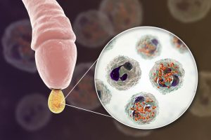 viem bao quy dau co tu khoi khong