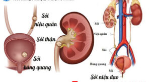 Tư Vấn & Điều Trị Nhiễm Trùng Tiểu, Viêm Niệu Đạo 4 Sỏi niệu đạo cũng là 1 nguyên nhân gây nhiễm trùng tiểu, viêm niệu đạo